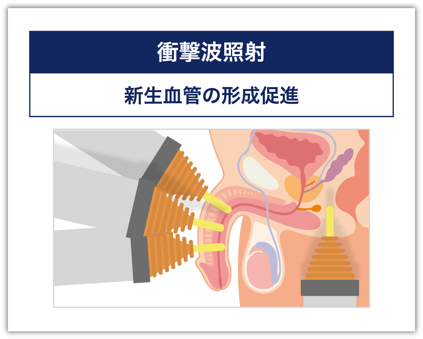 衝撃波照射