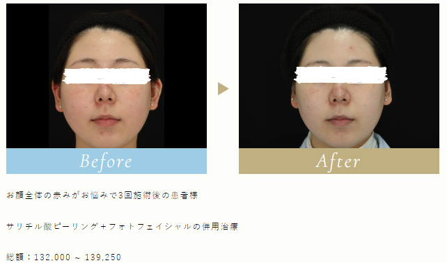 赤みが目立ちにくくなります