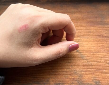 やけど（熱傷）