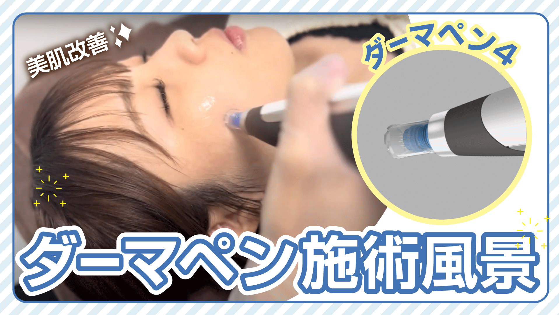 ダーマペン4でお肌の自然治癒力を呼び起こす！ニキビ跡やクレーター 