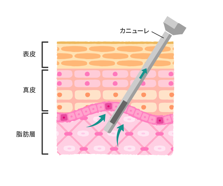 脂肪吸引による顔の引き締め