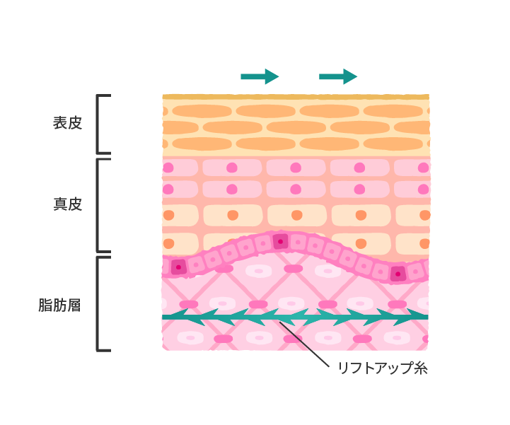 糸リフトによるリフトアップ