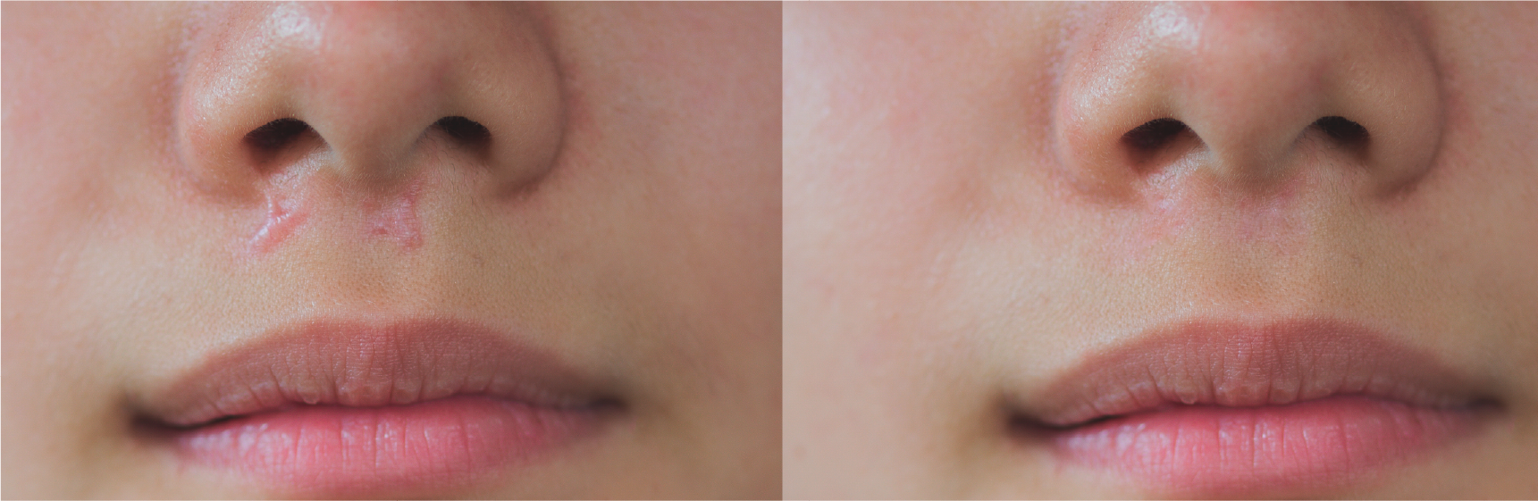 しこり(肥厚性瘢痕)・ケロイド