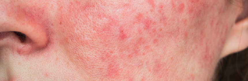 ニキビ跡➀ 赤み(赤いニキビ跡)の原因と治す方法