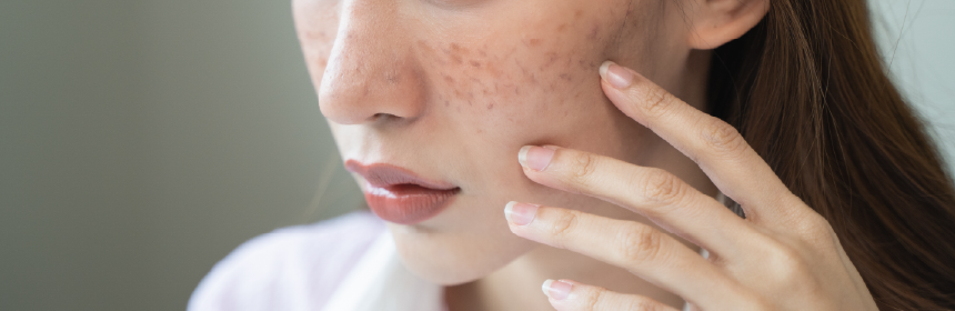 ニキビ跡➁ 色素沈着(茶色いニキビ跡)の原因と治す方法