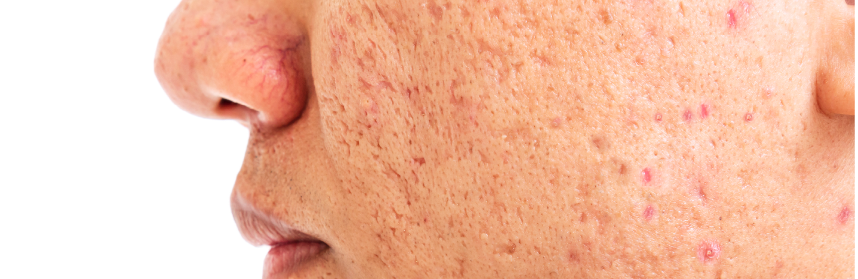 クレーター(萎縮性瘢痕)