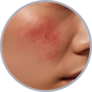 肝斑治療におけるエリシスセンスのメカニズム図