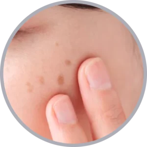 肝斑治療におけるエリシスセンスのメカニズム図