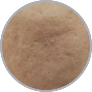 肝斑治療におけるエリシスセンスのメカニズム図