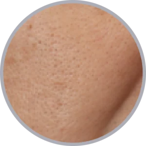 肝斑治療におけるエリシスセンスのメカニズム図