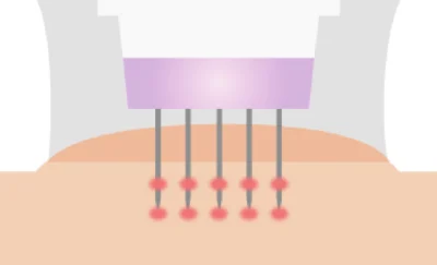 仕組み|針×RFで真皮に直接アプローチ