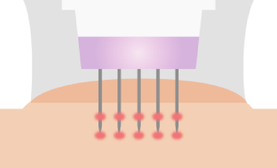 仕組み|針×RFで真皮に直接アプローチ