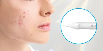 1PIN|ニキビ・皮脂腺へのピンポイント治療