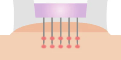 違い1照射方式(ダブルショット)