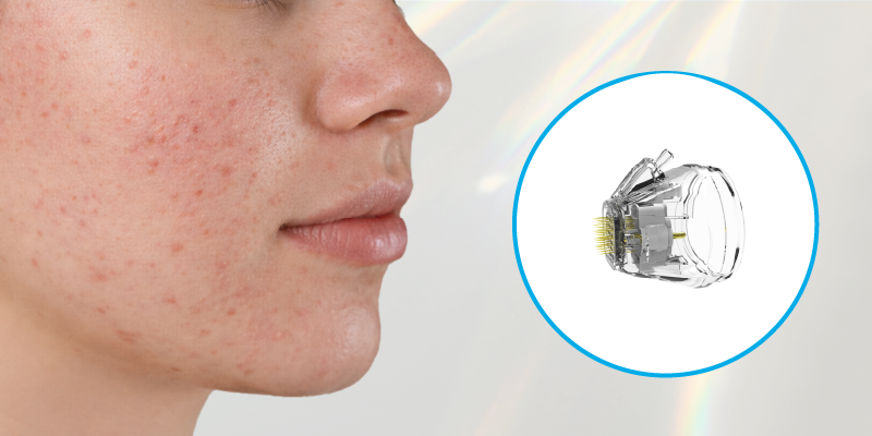 違い1照射方式(ダブルショット)